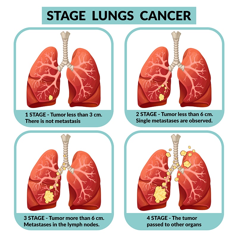 Stadi del cancro ai polmoni -  Credits: Saint John's Cancer Institute