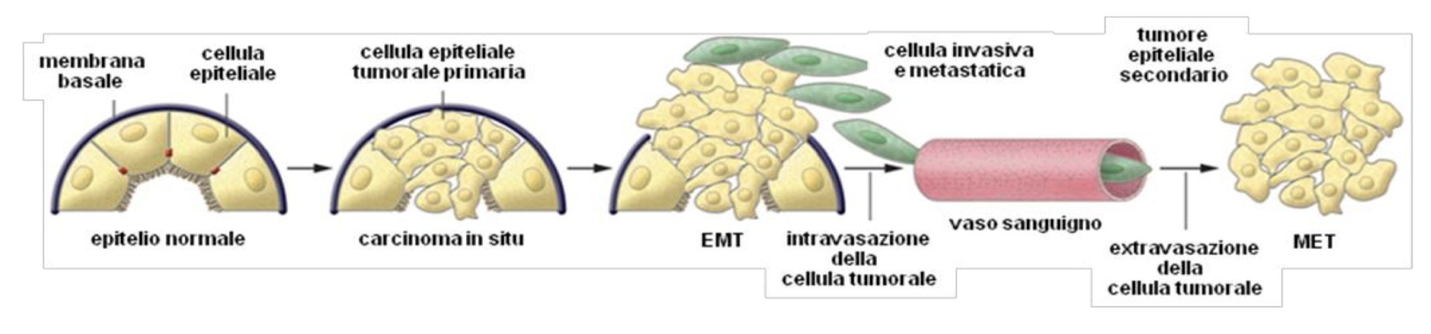 Figura rappresentativa delle fasi della EMT nella progressione tumorale - Credits: Journal of Clinical Investigation