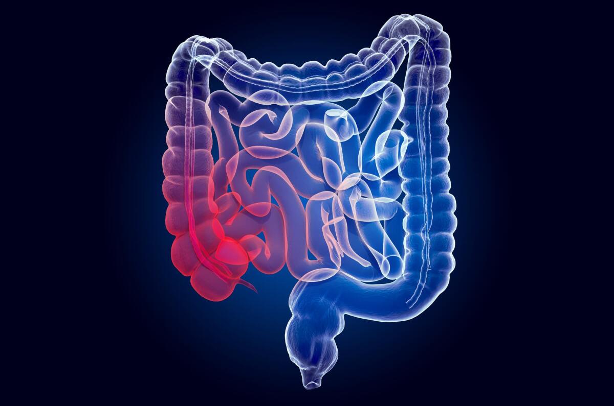 Cancro colon-retto: AI prevede la sopravvivenza nei pazienti - 