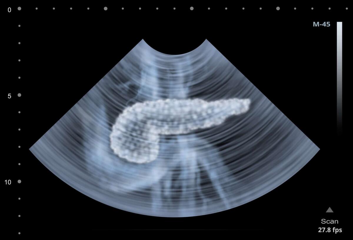 Cancro al pancreas: resistenza ai farmaci e proteina AKT - cancro al pancreas