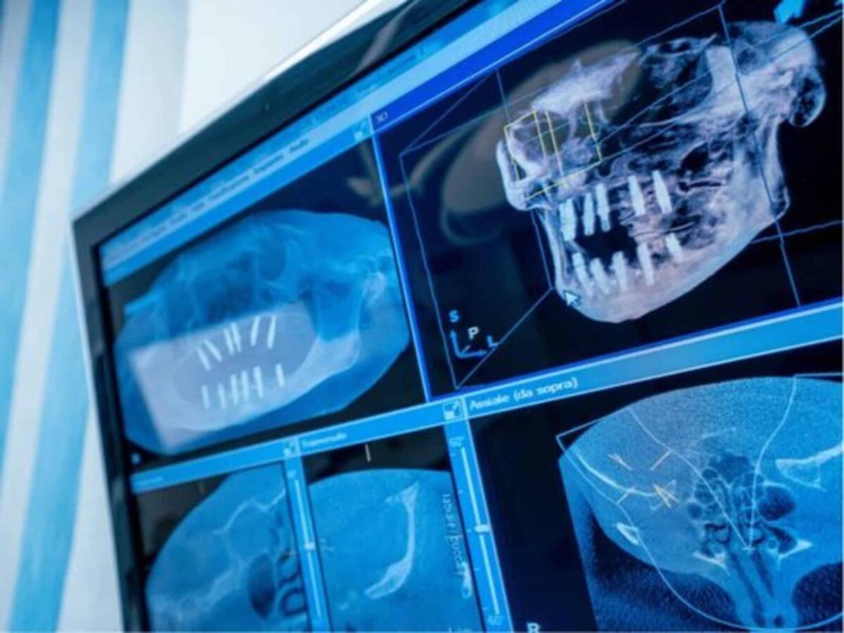 Le tecniche di implantologia a carico immediato più innovative - 