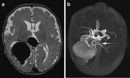 Una fistola arteroenosa (FAV) in un neonato che presenta insufficienza cardiaca e respiratoria - Credits:  Child's Nervous System