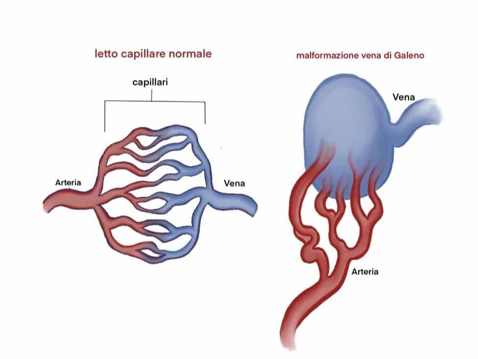 Anatomia della malformazione della vena di Galeno - Credits: IGG VGAM TEAM