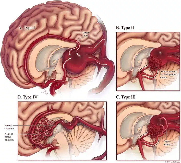 Diverse tipologie di malformazione della vena di Galeno -  Child's Nervous System