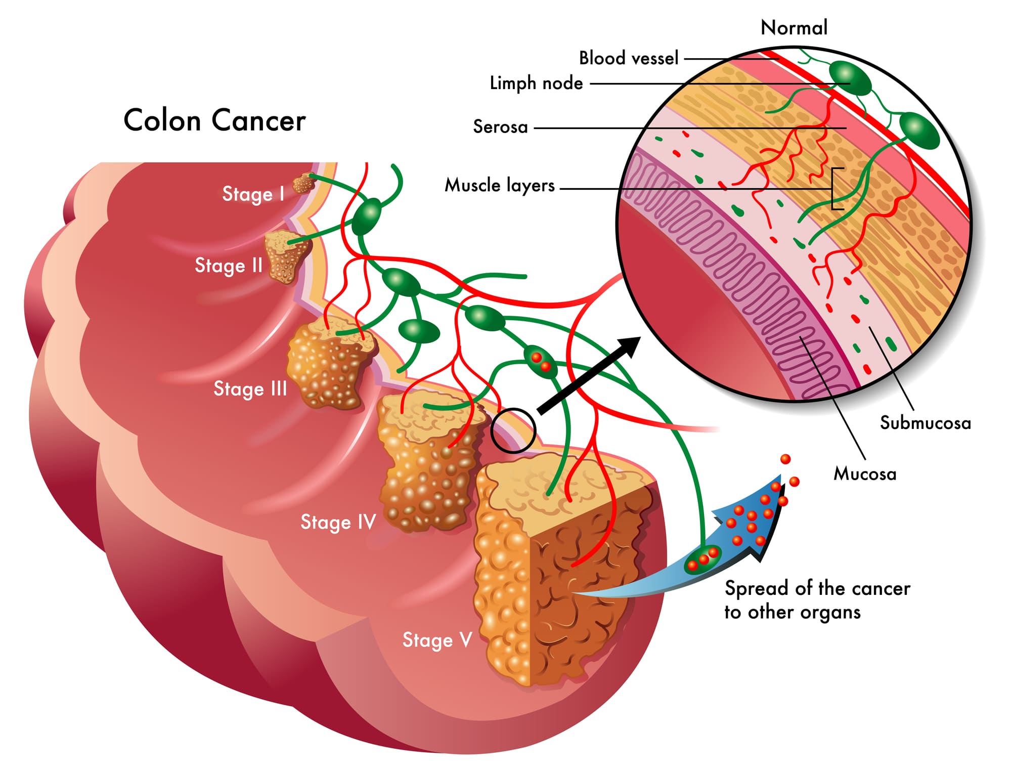 Raffigurazione del cancro colon-retto.