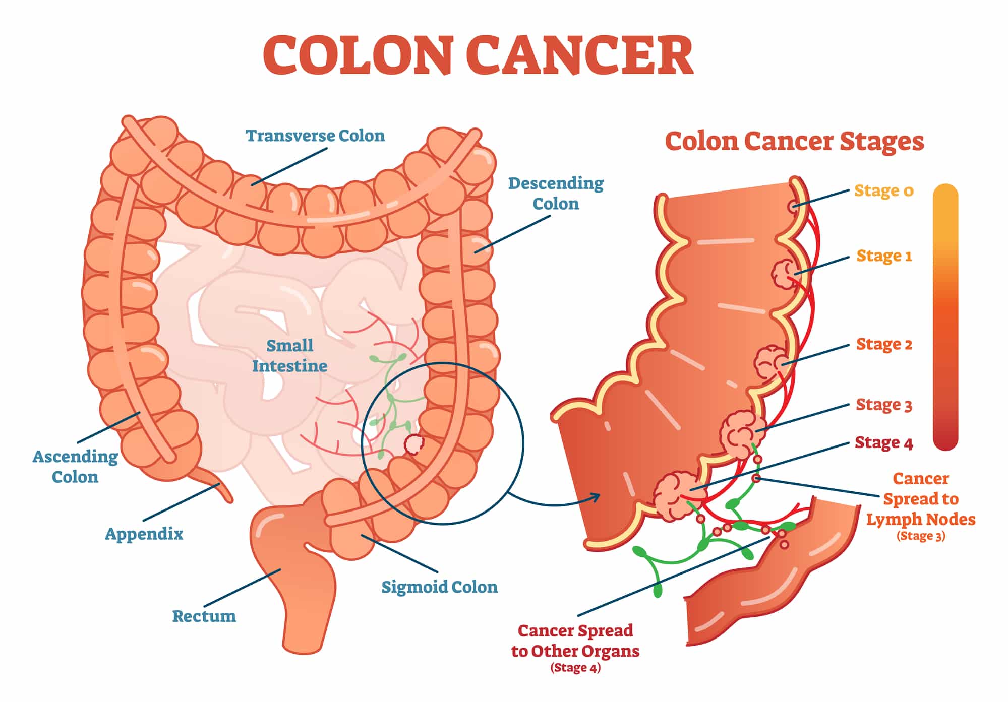 Cancro al colon-retto.