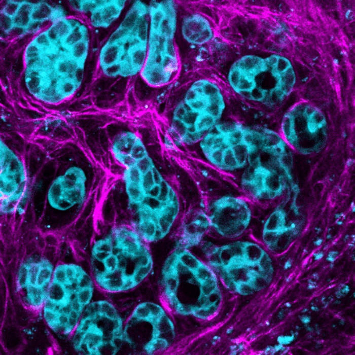 Le cellule tumorali nel pancreas attivano la molecola AKT (blu) per moltiplicarsi e diffondersi lungo lo stroma connettivo (rosa) nell'ambiente del cancro - Credits: Max Nobis (VIB-KU Leuven Center for Cancer Biology)
