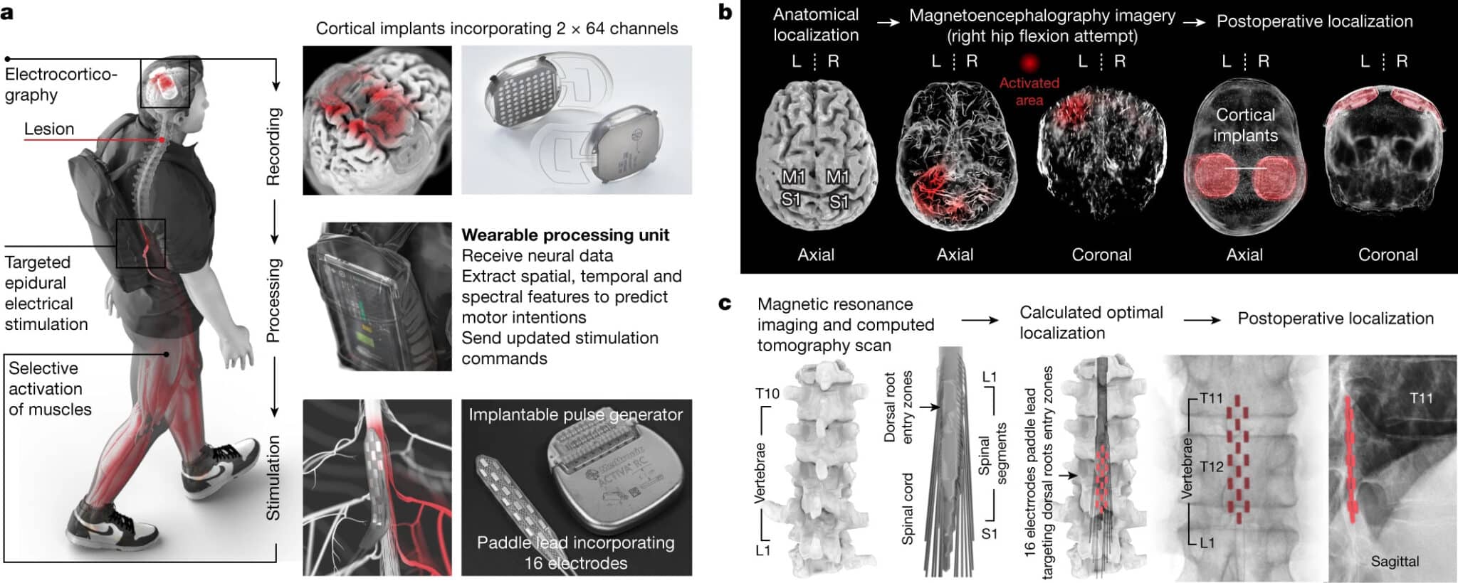 Credits- Nature. La sezione (a) dell'immagine illustra il dispositivo appena descritto. La parte (b) riporta la pianificazione preoperatoria delle posizioni degli impianti, quella (c) il modello computazionale personalizzato che prevede la locazione ottim