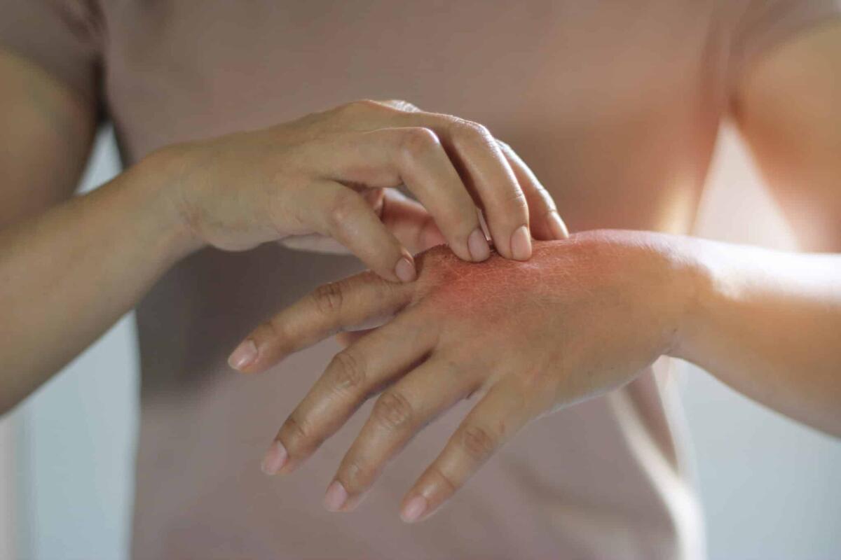 Miliaria, l'eruzione cutanea causata dal calore - Healthcare and medical concept. Female scratching the itch on her hand, cause of itching from skin diseases, dry skin, allergy, chemical, allergic to detergent or dishwashing liquid and dermatitis, insect bites, burned, drug. Health problem.