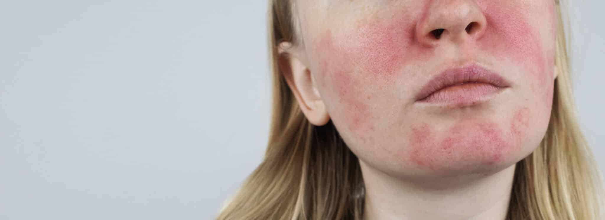 Dermatite atopica: cause e nuovi trattamenti