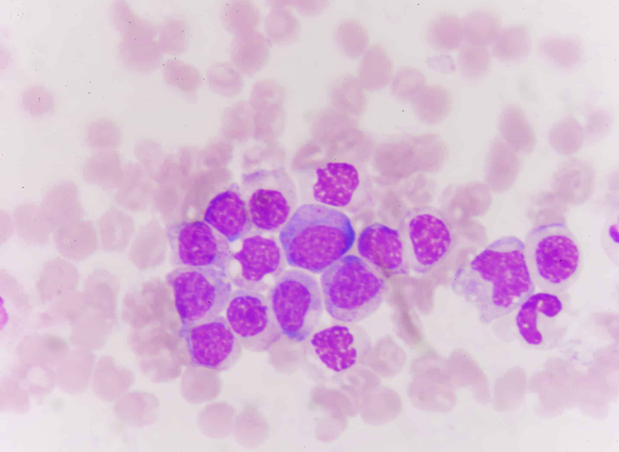 Cellule blastiche in leucemia