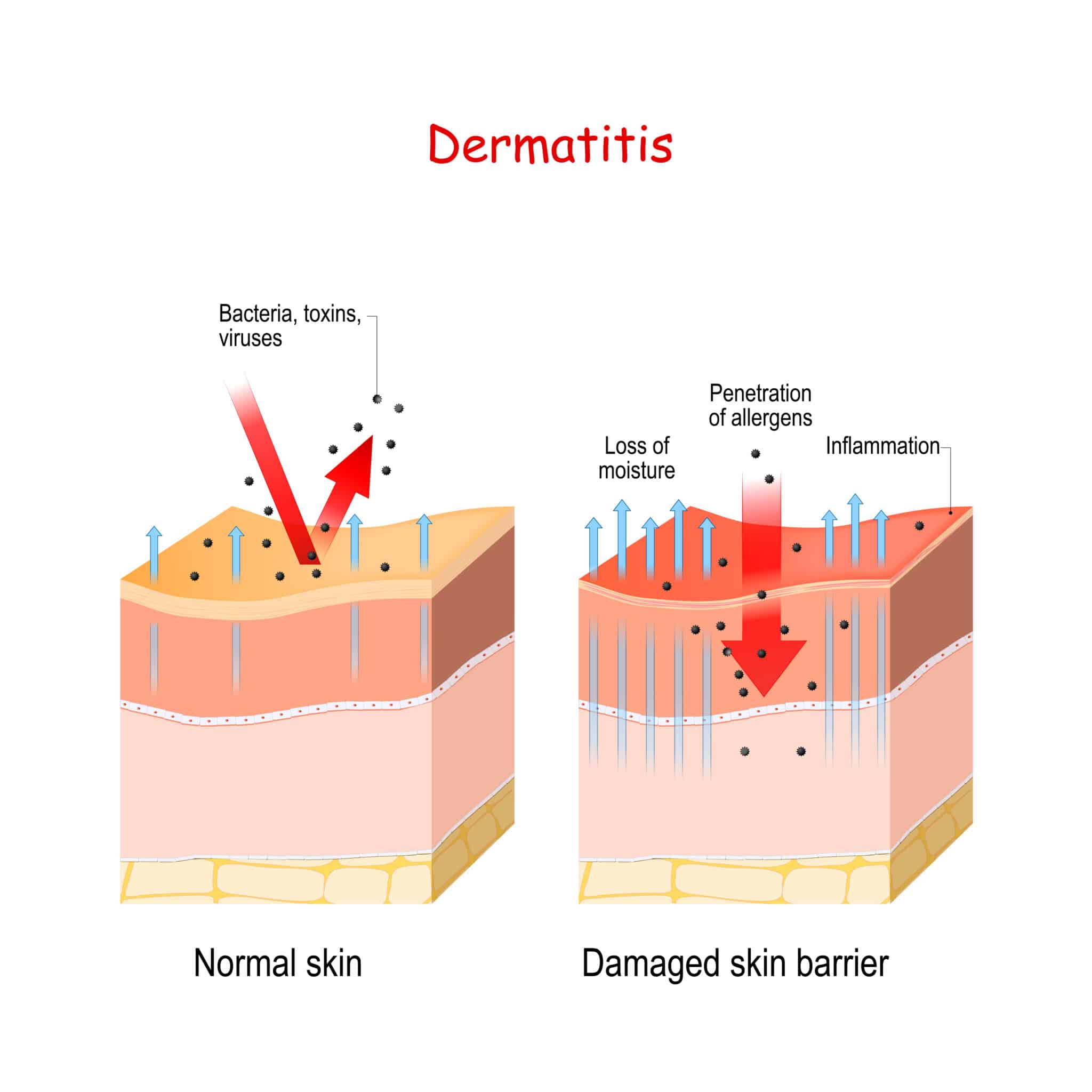 dermatite atopica