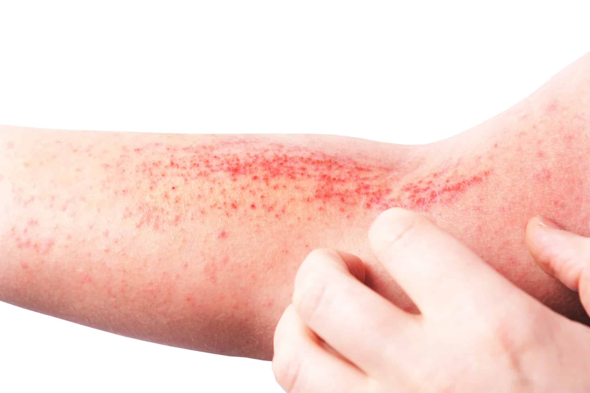 dermatite atopica