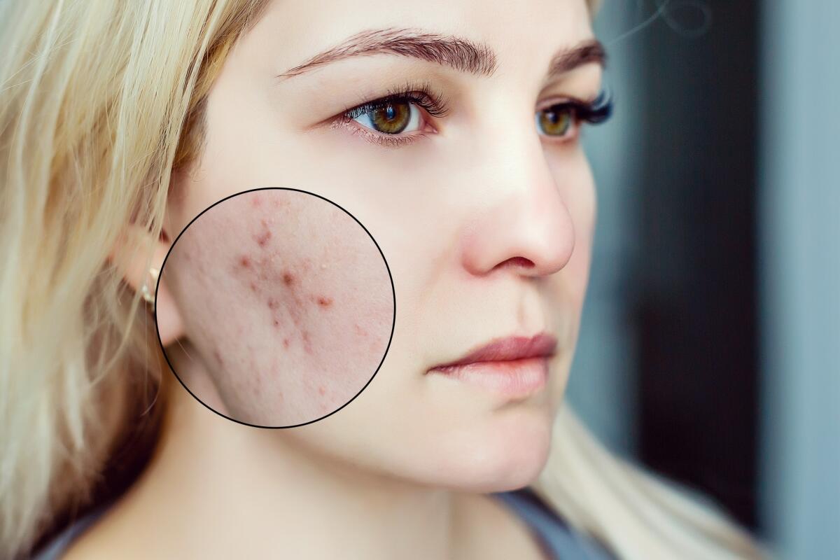 Acne: nuova terapia ed il cerotto con microaghi - acne