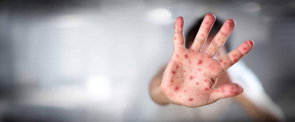 Rosolia: in Italia è stata sconfitta - 