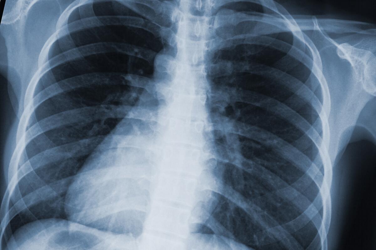 Radiografia toracica: modello AI associa funzioni cardiache - raggi x torace