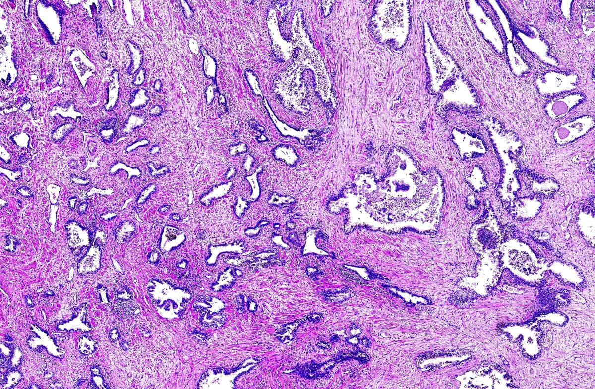 Cancro alla prostata: scoperti nuovi biomarcatori - cancro prostata