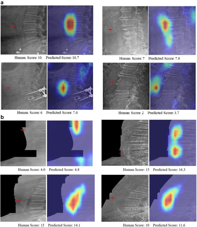 Prestazioni qualitative del modello su immagini affiancate senza mappa di attivazione (a sinistra) e con mappa di attivazione (a destra) - Credits: EBioMedicine
