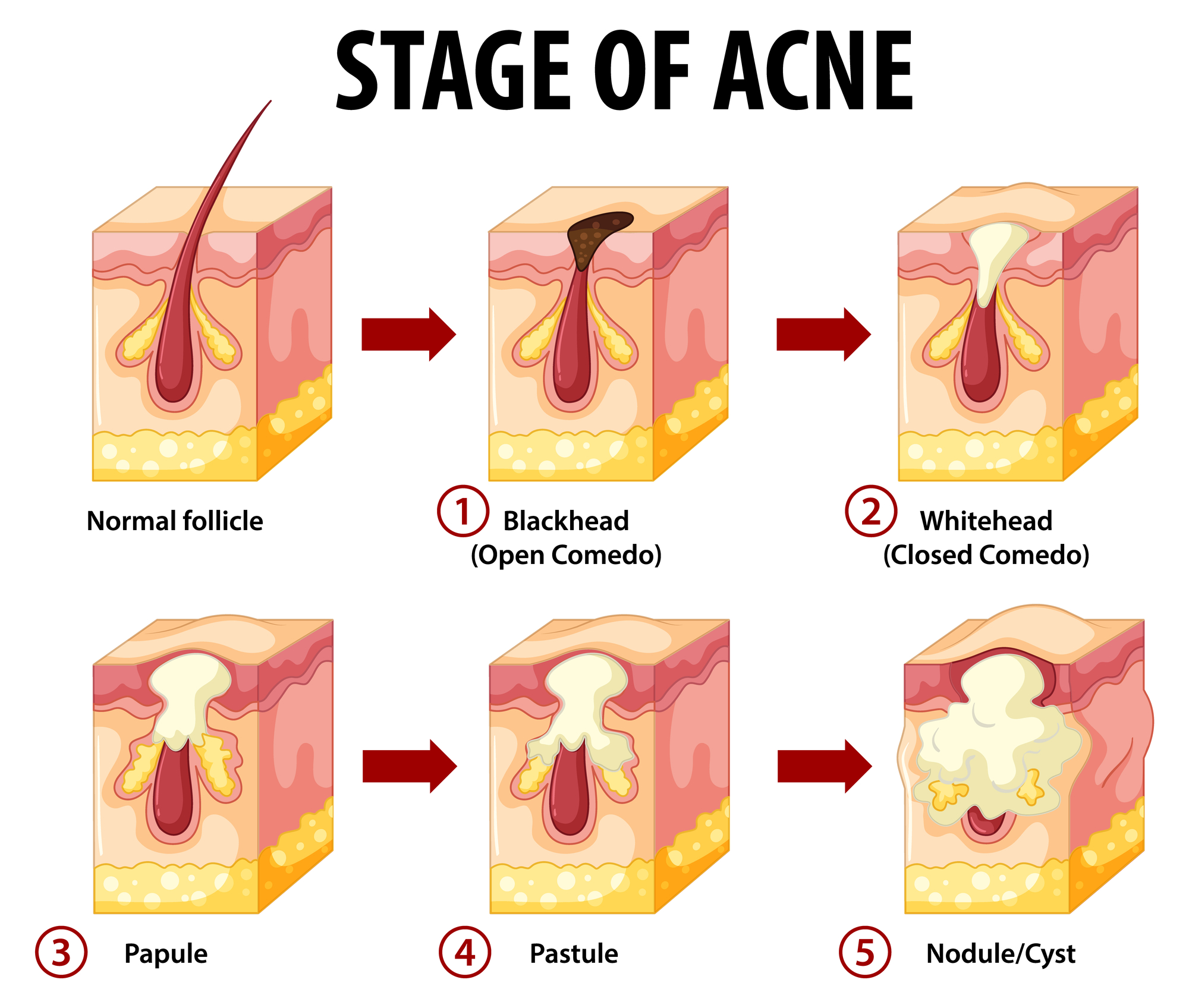 Stati di formazione dell'acne.