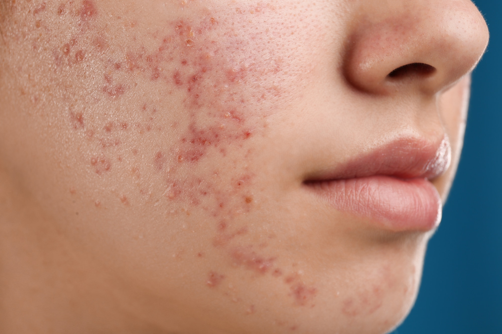In figura un paziente affetto da acne.