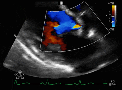 In figura un ecocardiogramma - Credits: Cardiovascular Interventions