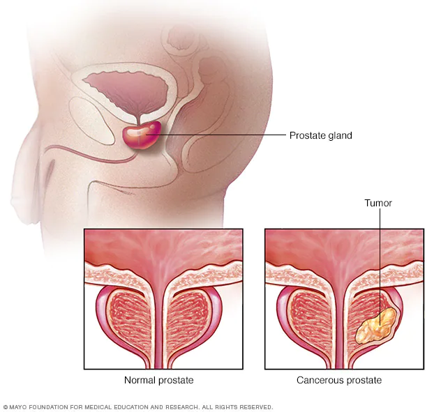 Il cancro alla prostata interessa la ghiandola prostatica - Credits: Mayo Clinic