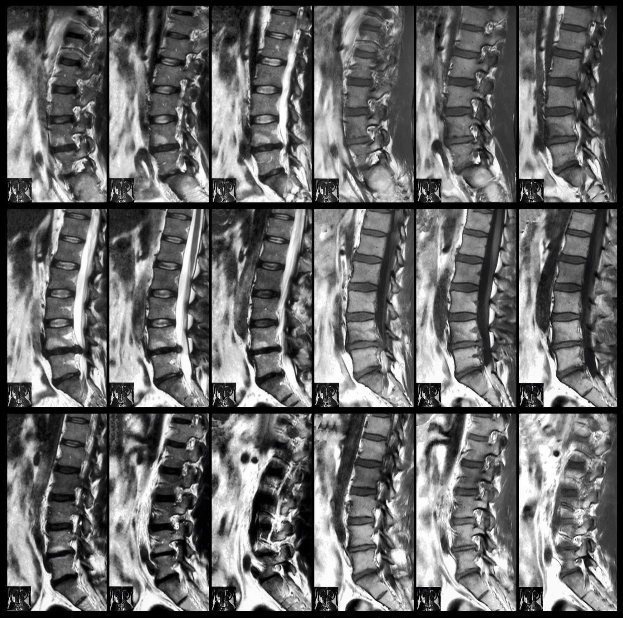 In figura delle immagini MRI della colonna vertebrale.