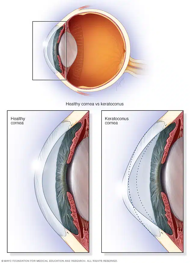 Differenza tra un paziente sano ed uno con cheratocono - Credits: Mayo Clinic