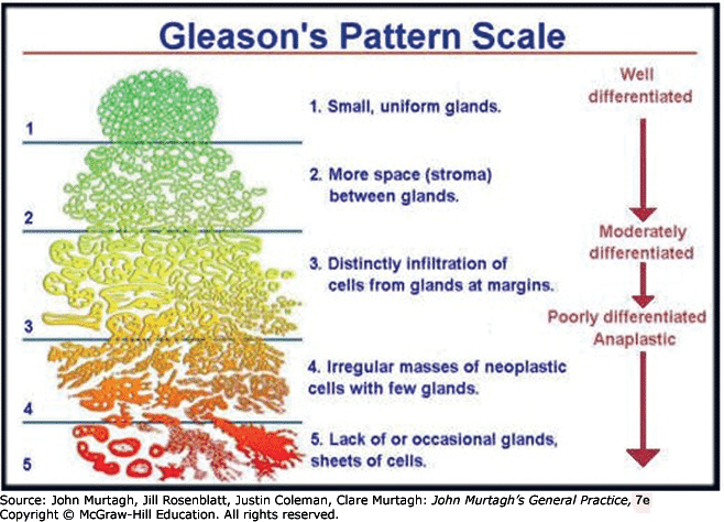 Punteggio di Gleason - Credits: Prostate Conditions Education Council