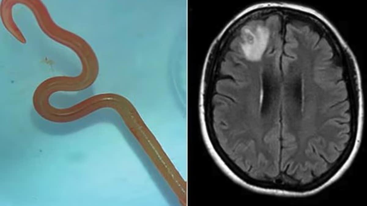 Estratto un verme di 8 cm dal cervello di una donna - 