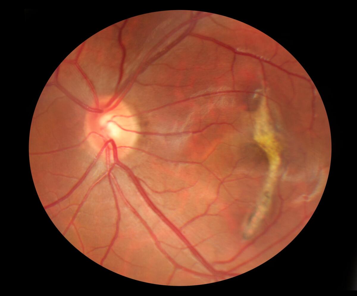Degenerazione maculare: nuova terapia con crescita cellulare - Fundus photo of macular scarring with normal blood vessels and optic nerve
