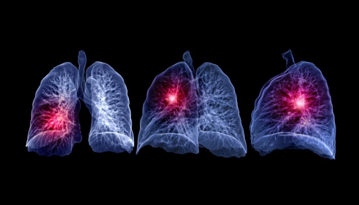 CAD system: un software per  i noduli polmonari - Collection of CT Chest or Lung 3D rendering image showing lesion for diagnosis TB,tuberculosis and covid-19 .