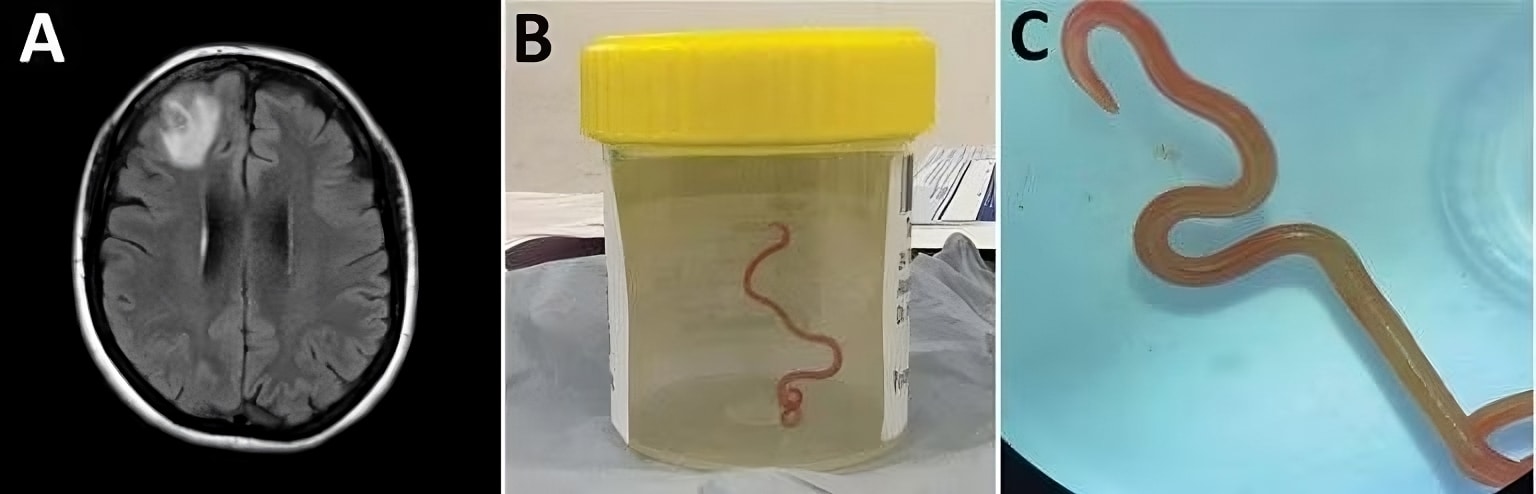 Credits - Human Neural Larva Migrans Caused by Ophidascaris robertsi Ascarid -  Rilevamento di infezione da nematode  Ophidascaris robertsi in una donna di 64 anni del New South Wales sudorientale, Australia.  A) Immagine di risonanza magnetica del cervel