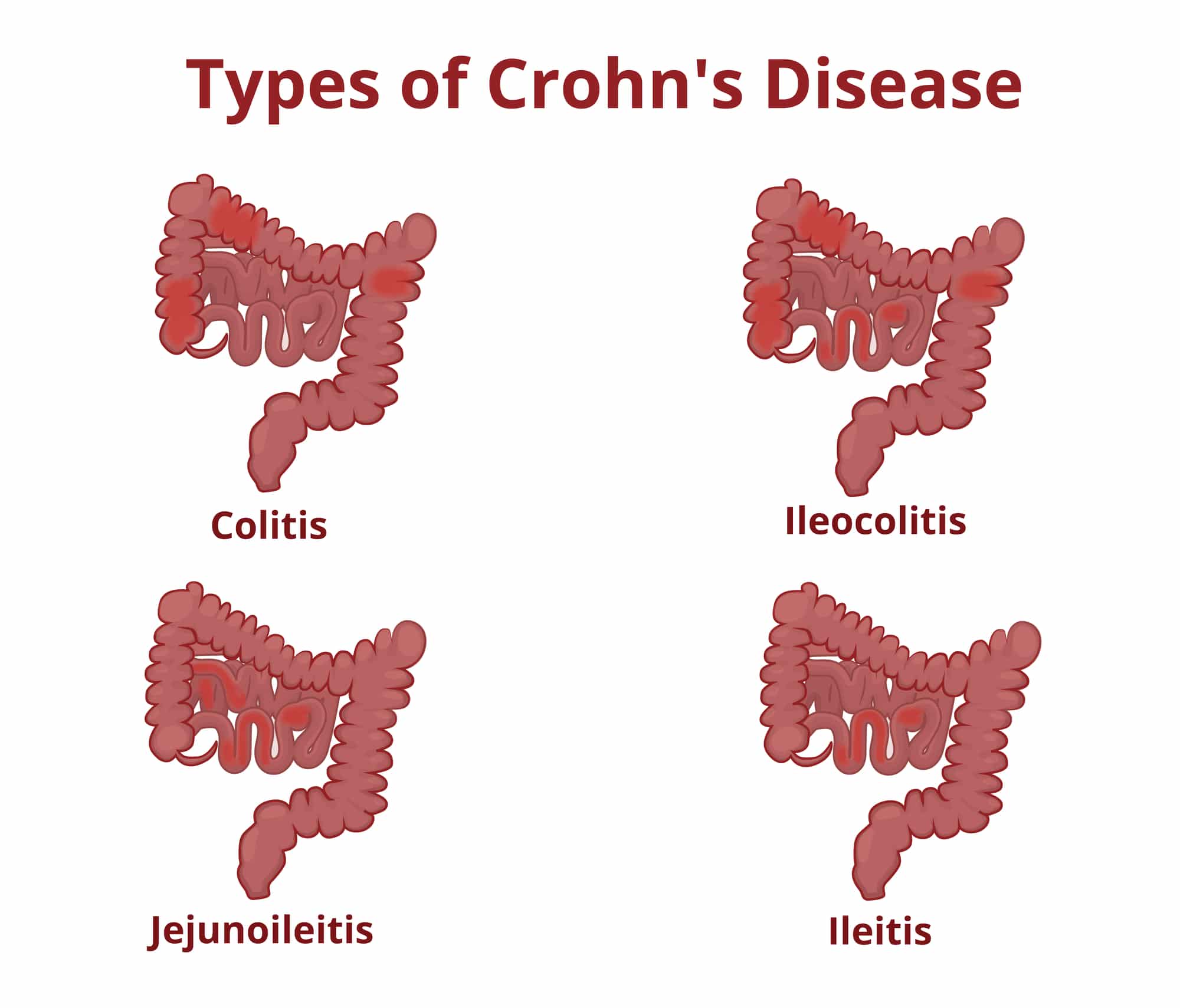 In figura le quattro diverse tipologie di Morbo di Crohn.