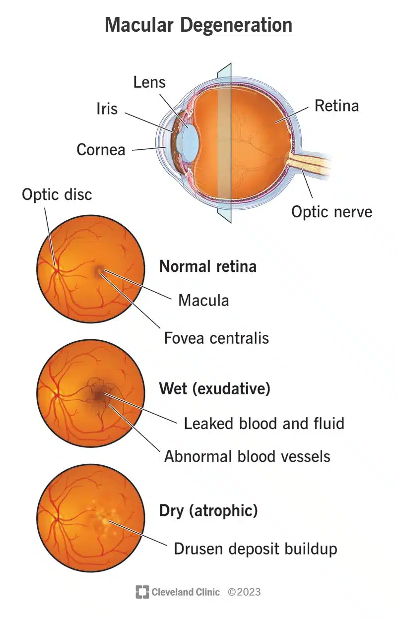In foto sono visibili sia la forma umida (essudativa) che quella secca (atrofica) della degenerazione maculare - Credits: Cleveland Clinic