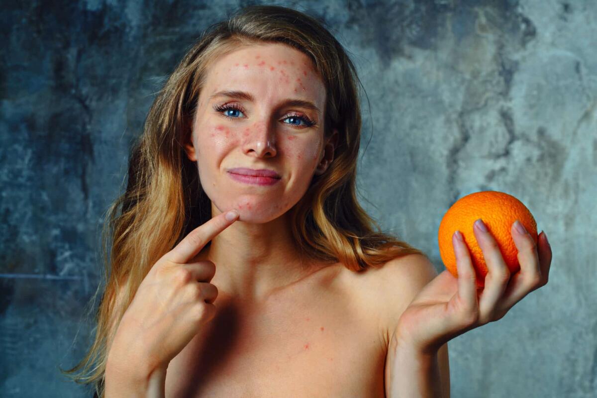 Uno studio conferma che nelle allergie alimentari c'entra anche la pelle - Young woman have allergy on orange. Face have a lot of acne and she is very unhappy.