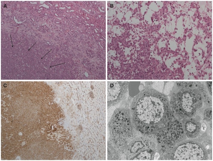 Istopatologia del reninoma. (A) Ematossilina ed eosina, ingrandimento ×200. Le frecce puntano al tumore a cellule iuxtaglomerulari (reninoma). Una capsula fibrosa incompleta (basi di freccia) separa il tumore dal rene normale (l'angolo in alto a destra). 