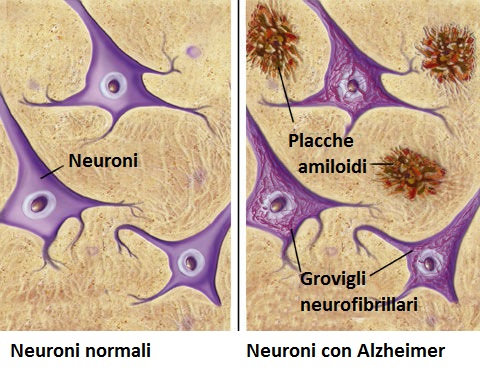 Tessuto nervoso di pazienti sani e affetti da Alzheimer. In questi ultimi si osservano accumuli extracellulari di sostanza amiloide, che formano le placche e i grovigli neurofibrillari - Credits: PubMed