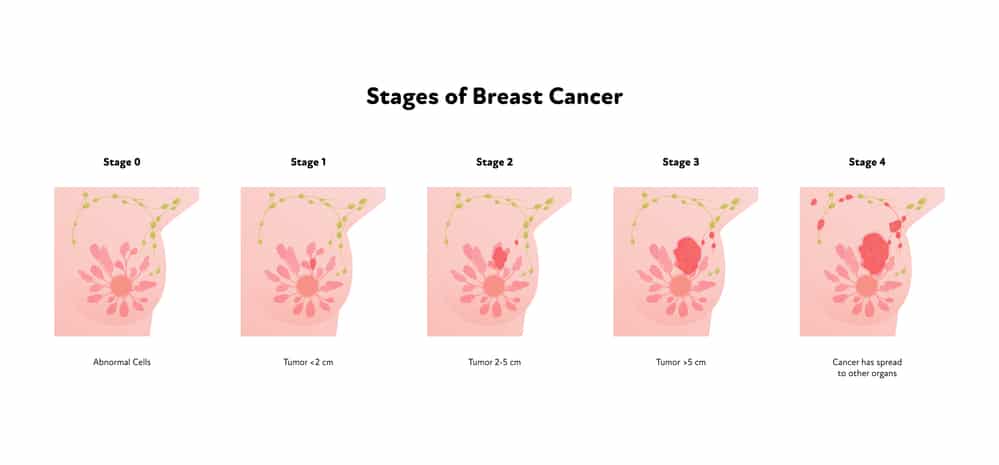 Sati del cancro al seno
