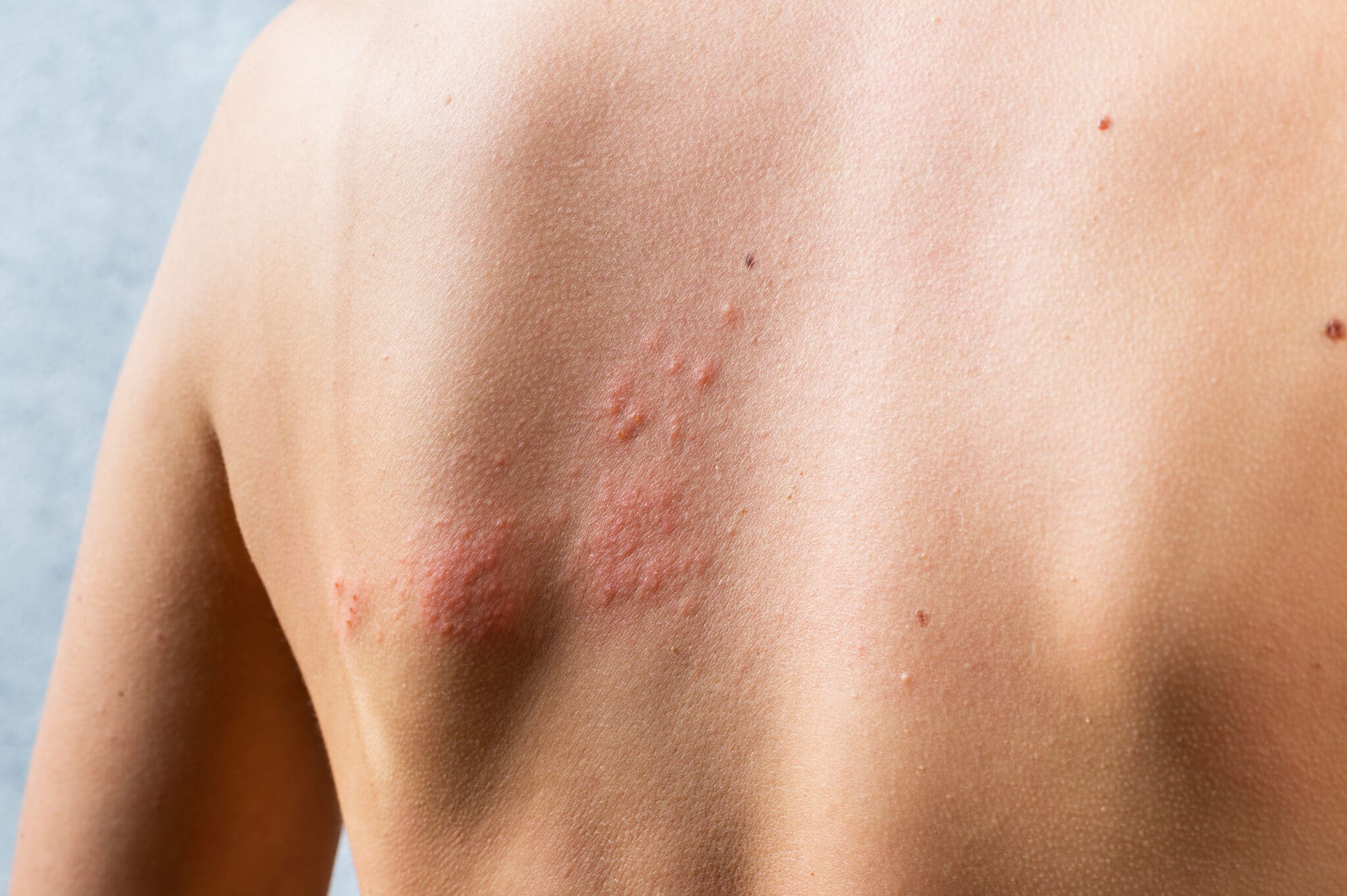 Orticaria acquagenica