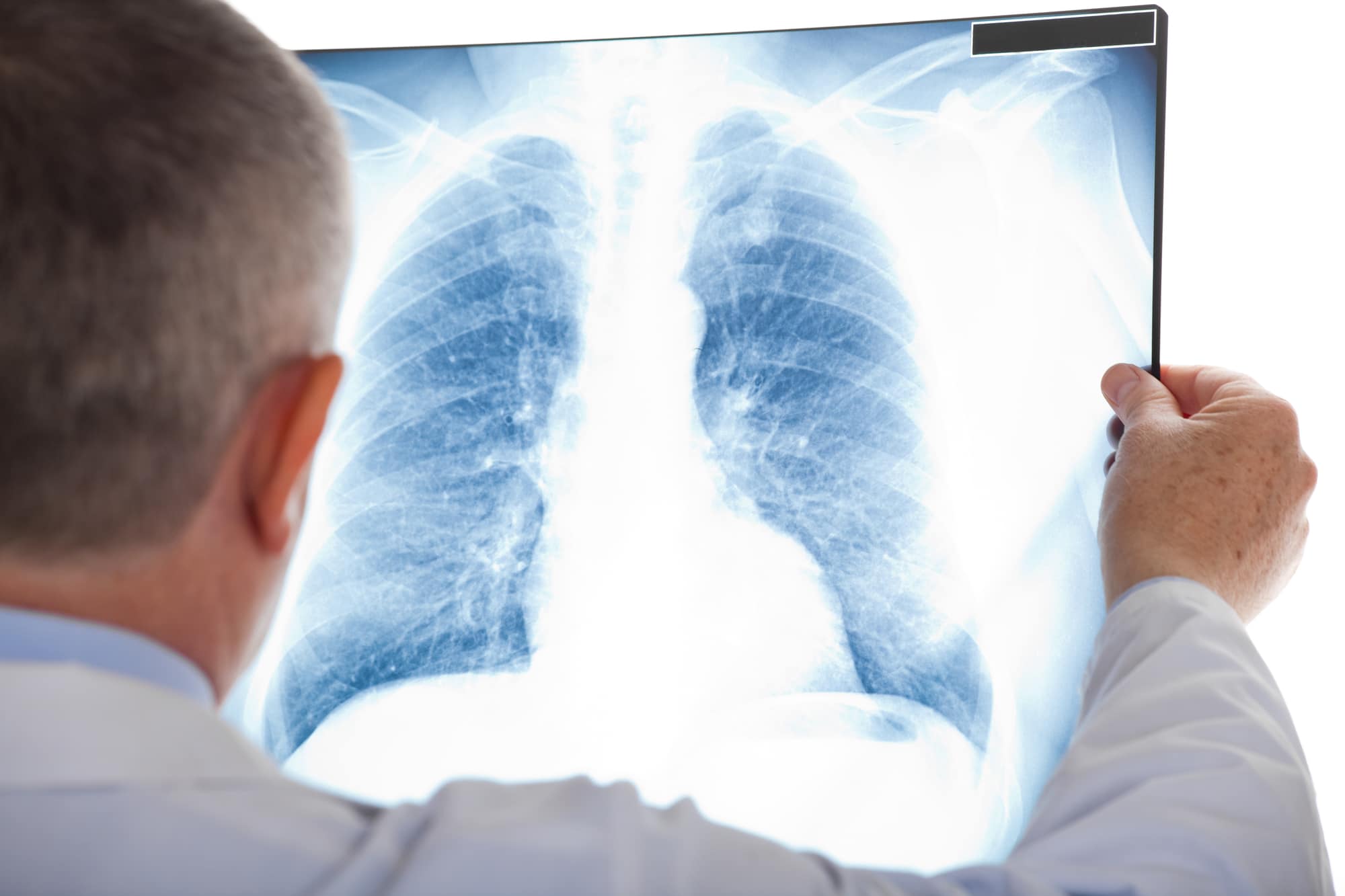 ALCASE: la prima e unica organizzazione no-profit italiana interamente dedicata al cancro del polmone