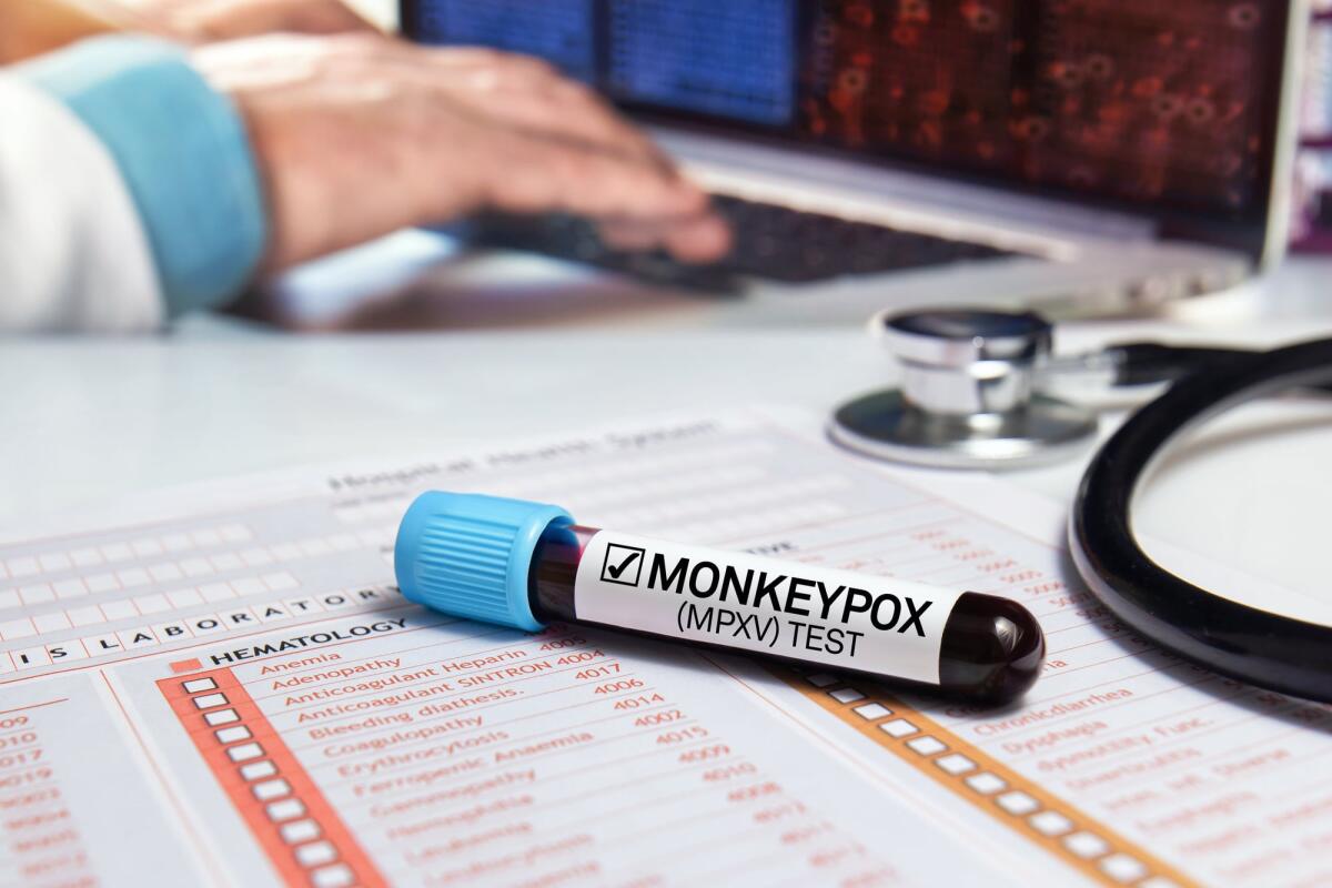Vaiolo delle scimmie in Toscana: 10 nuovi casi a Firenze da metà gennaio - medical office work table with a blood sample from a patient positive for monkey pox virus (MPXV). Doctor's work table with a blood tube diagnosed infection with Monkeypox (MPXV) disease