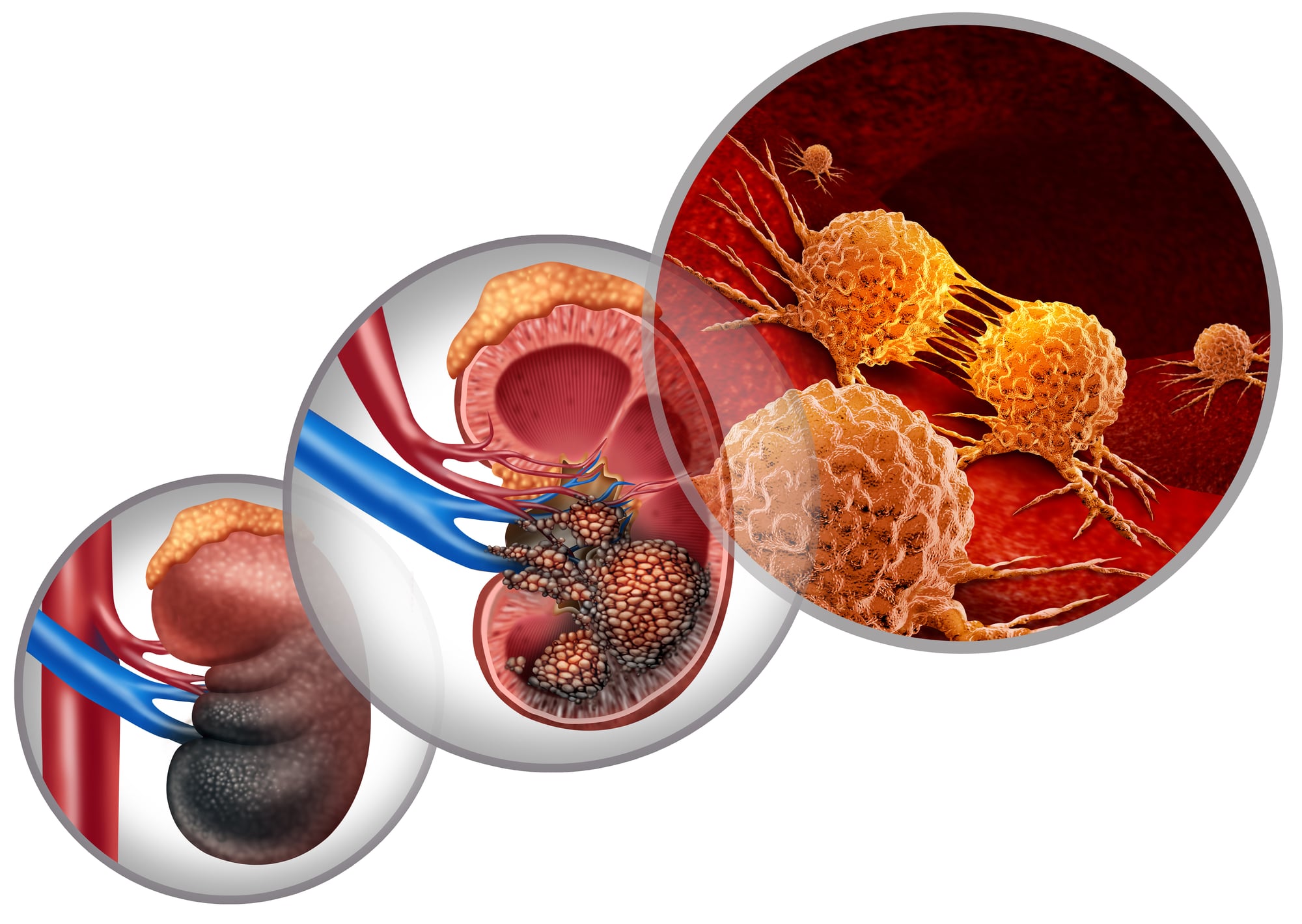 Nefrectomia parziale: cos'è e perché è un approccio innovativo contro il tumore del rene