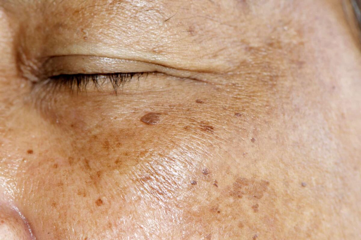 Cancro della pelle: nuove tecniche per diagnosticarlo - 