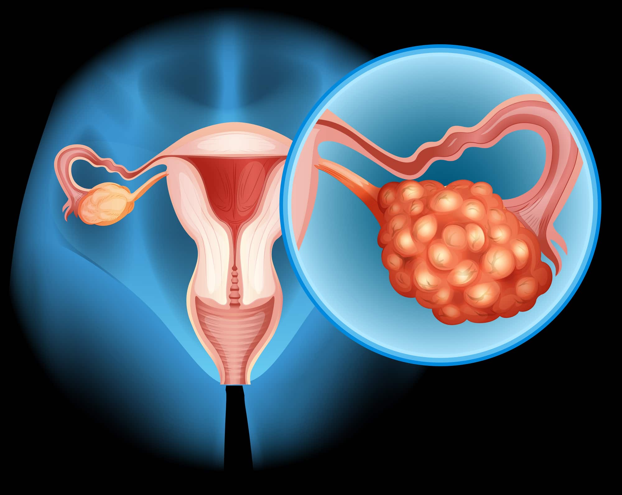 La diagnosi precoce del cancro ovarico potrebbe essere fatta con un test delle urine