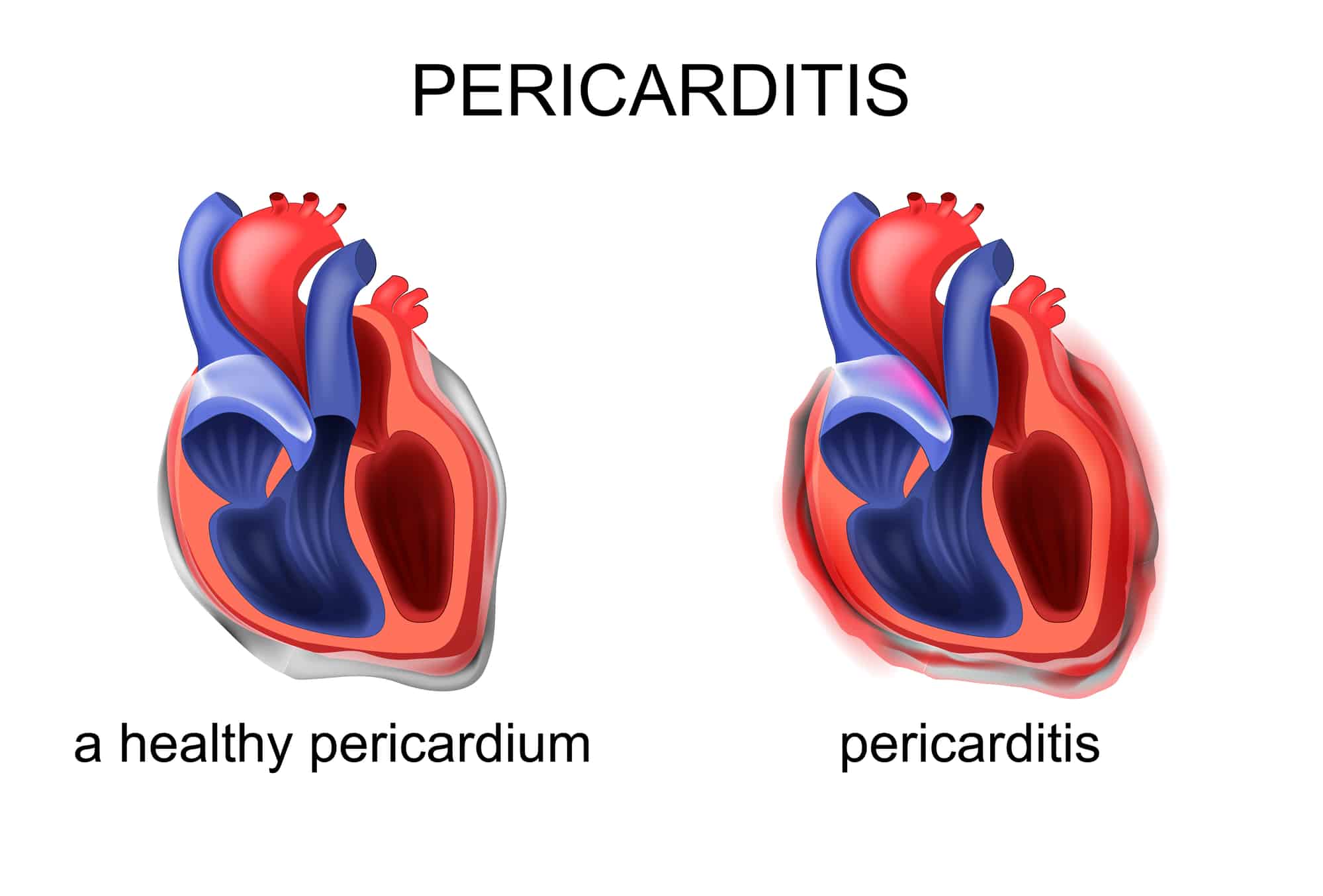 Pericardite