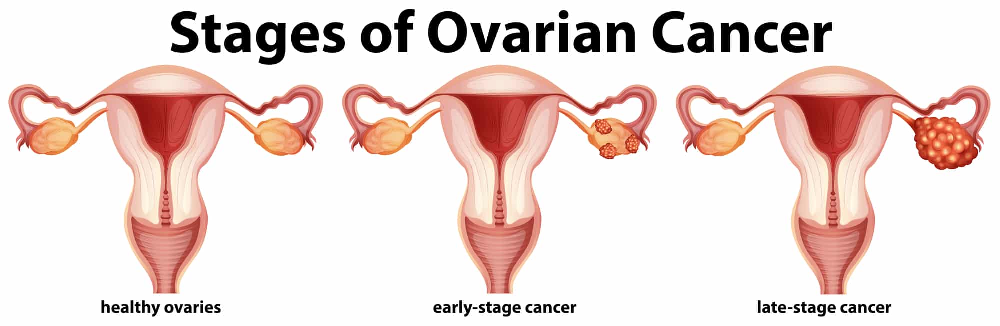 La diagnosi precoce del cancro ovarico potrebbe essere fatta con un test delle urine