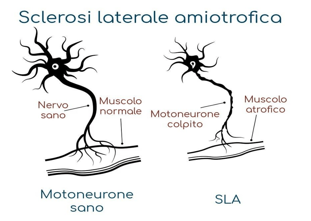 trattamento della SLA