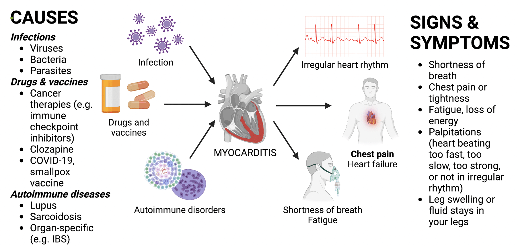 Cause e sintomi della miocardite - Credits: University of California