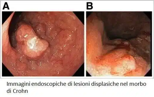 Esami endoscopici di pazienti affetti da Morbo di Crohn - Credits: gastroenterologoiannetti.com